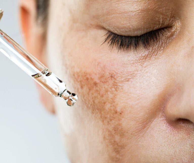 hilangkan jeragat melasma