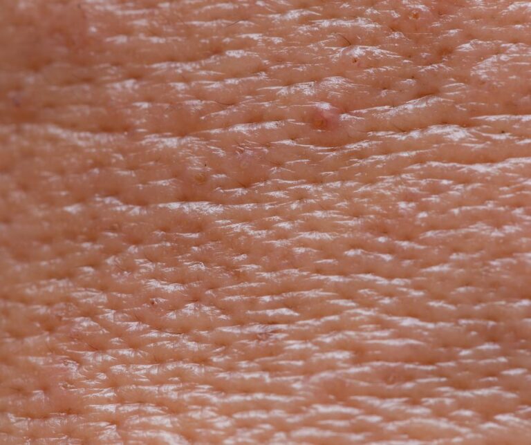 Punca kulit berminyak