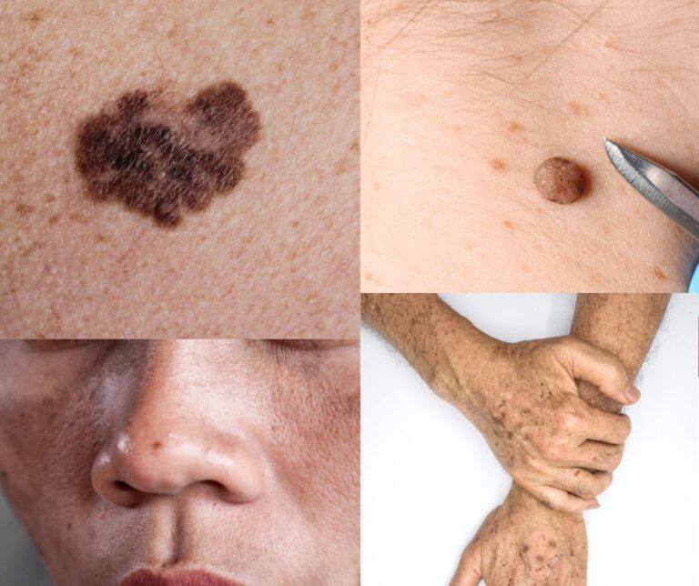 bintik hitam di wajah