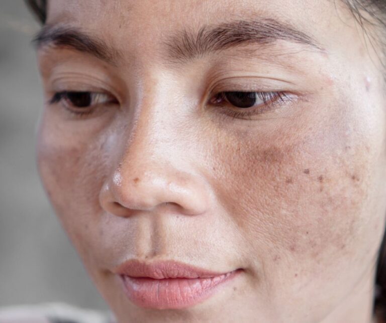 jeragat melasma